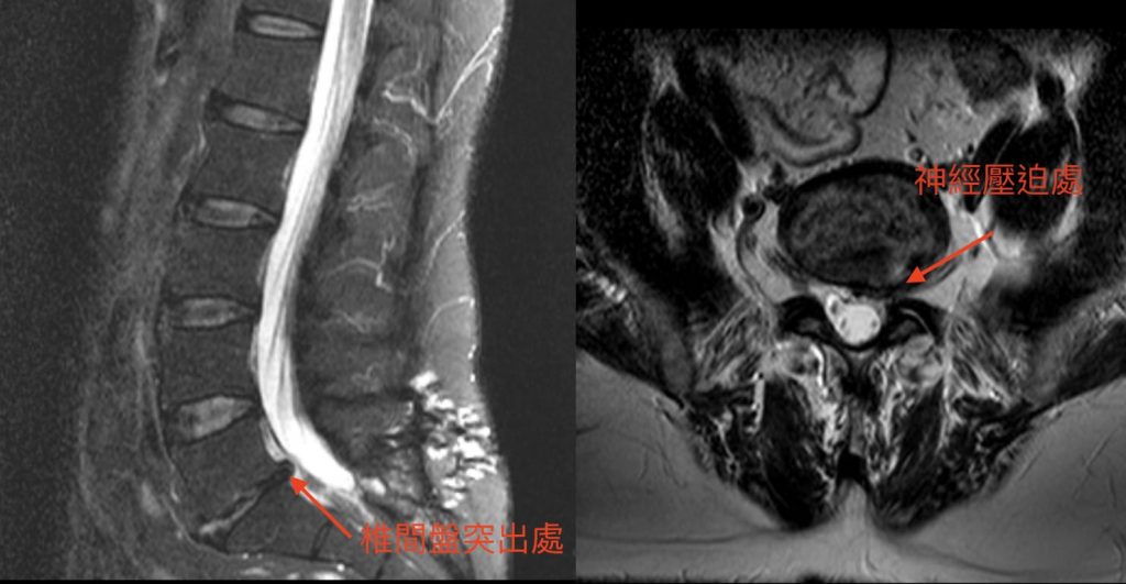 椎間盤突出手術-雙通道內視鏡-脊椎微創手術-永和骨科推薦-陳奕霖醫師