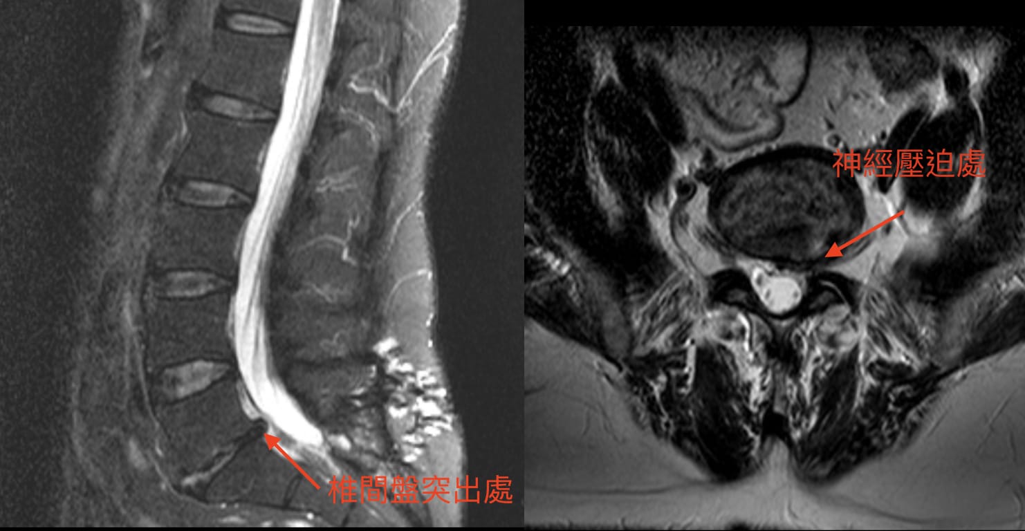 椎間盤突出腳麻怎麼辦 雙通道內視鏡脊椎微創手術 減壓風險小效果好 椎間盤突出腳麻怎麼辦 雙通道內視鏡脊椎微創手術 減壓風險小效果好