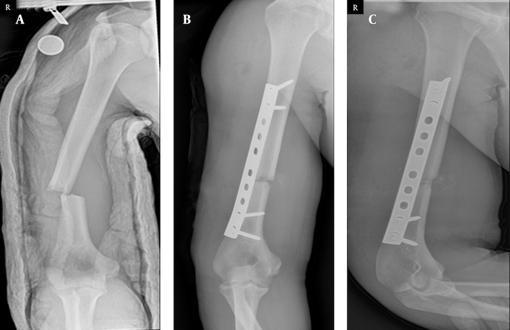 上臂骨折患者使用鋼板做內固定的X光圖-傷口面積較大且破壞較多