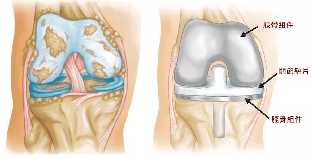 膝蓋痛-骨刺-膝關節炎-人工膝關節置換手術推薦-手術前後關節構造圖