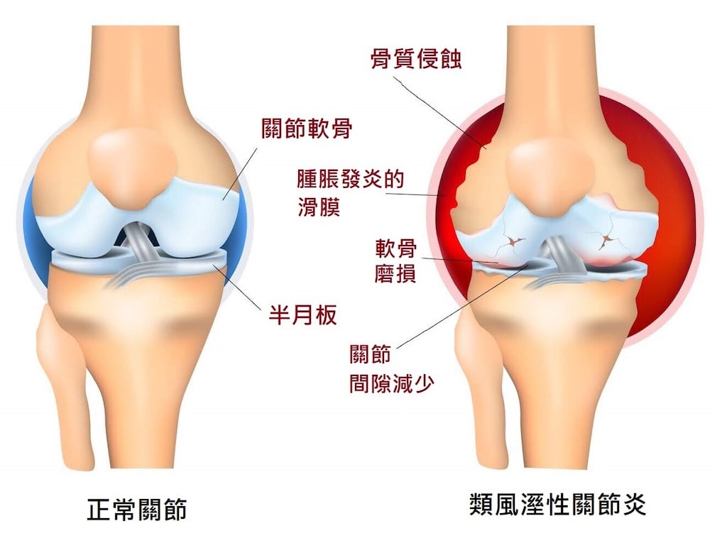 膝蓋痛-骨刺-膝關節炎-人工膝關節置換手術推薦-類風濕性關節炎患者膝蓋狀況