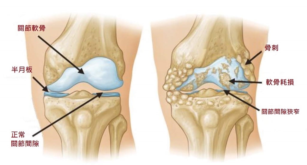膝蓋痛-骨刺-膝關節炎-人工膝關節置換手術推薦-骨關節炎患者膝蓋狀況