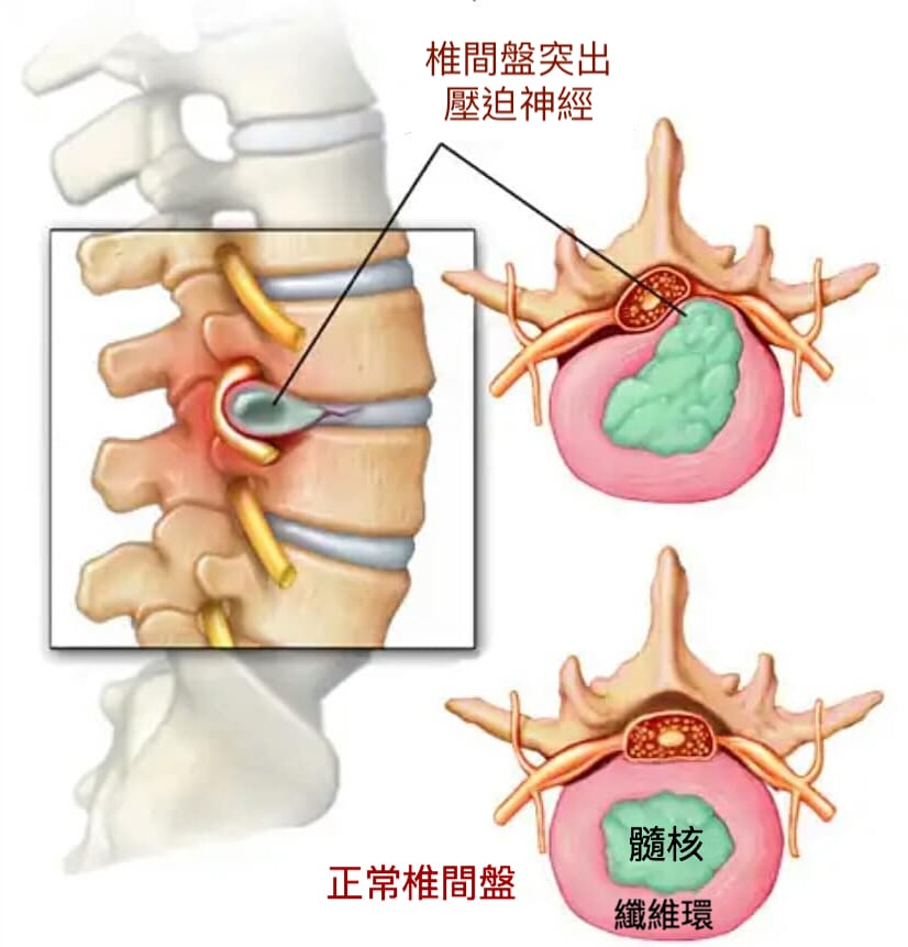 微創脊椎內視鏡手術是什麼-椎間盤突出-坐骨神經痛-椎間管狹窄推薦必看-椎間盤突出示意圖
