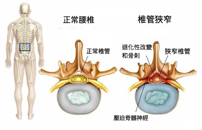 微創脊椎內視鏡手術是什麼?-椎間盤突出-坐骨神經痛-椎間管狹窄推薦必看-脊椎椎管狹窄示意圖