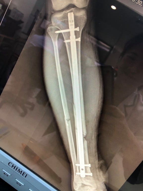 獨木舟翻覆小腿骨折 髓內釘手術固定治療 骨折開刀手術患者分享心得 永和骨科陳奕霖醫師 獨木舟翻覆小腿骨折 髓內釘手術固定治療 骨折開刀手術患者分享心得 永和骨科陳奕霖醫師