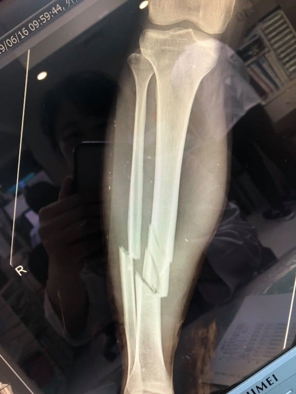 獨木舟翻覆小腿骨折 髓內釘手術固定治療 骨折開刀手術患者分享心得 永和骨科陳奕霖醫師 獨木舟翻覆小腿骨折 髓內釘手術固定治療 骨折開刀手術患者分享心得 永和骨科陳奕霖醫師