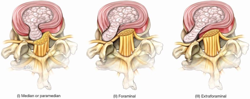 椎間盤突出-症狀與治療-腳麻-下背痛-坐骨神經痛推薦必看-依椎間盤突出的位置不同會壓迫不到不同的神經根