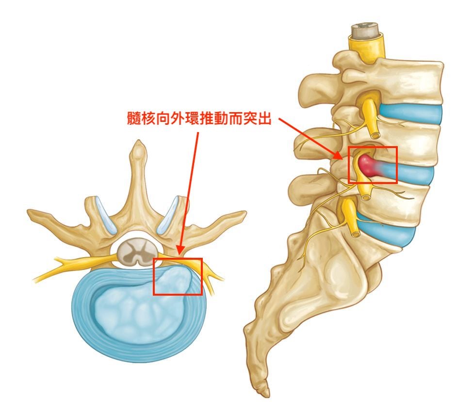 椎間盤突出-症狀與治療-腳麻-下背痛-坐骨神經痛推薦必看-椎間盤突出刺激到神經產生疼痛