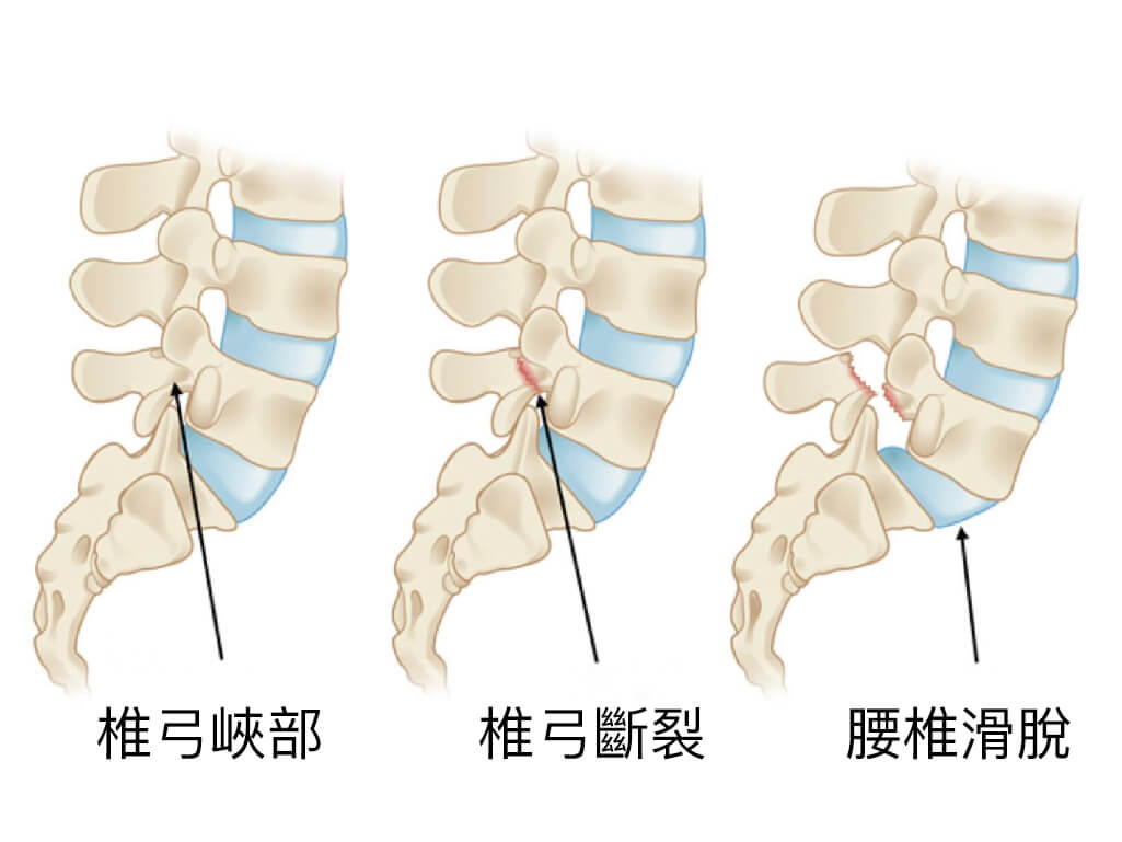 脊椎滑脫是什麼 詳解椎弓斷裂 腰椎椎間盤滑脫症狀和手術治療方式