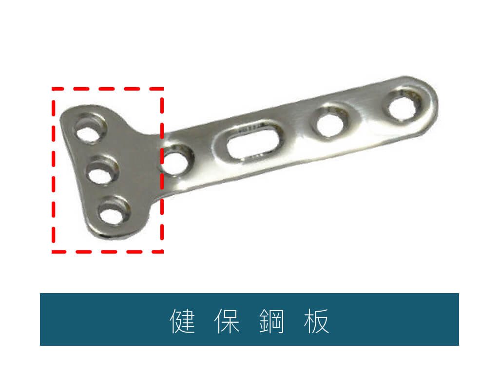 骨折開刀大哉問 骨折處理推薦必看ｑ ａ 陳奕霖醫師 永和骨科推薦