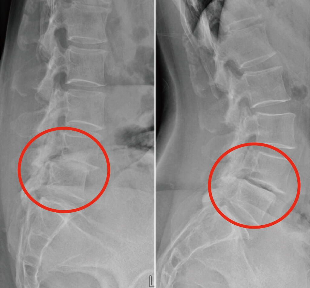 下背痛-腰椎滑脫-椎弓解離-永和骨科推薦-陳奕霖醫師-從側面拍攝的X光片，幫助醫生確定椎體滑脫的程度