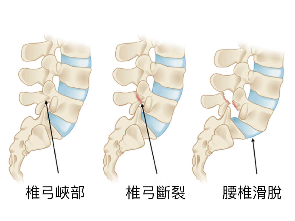 下背痛-腰椎滑脫-椎弓解離-永和骨科推薦-陳奕霖醫師-椎弓斷裂可能造成腰椎滑脫