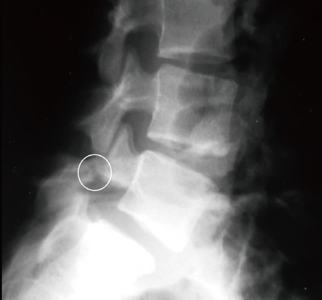 下背痛-腰椎滑脫-椎弓解離-永和骨科推薦-陳奕霖醫師-透過X光片看到第四或第五腰椎的椎弓峽部產生裂縫或應力性⻣折，可診斷為椎弓斷裂