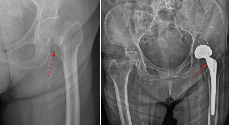 股骨頸骨折處及置換完半人工髖關節