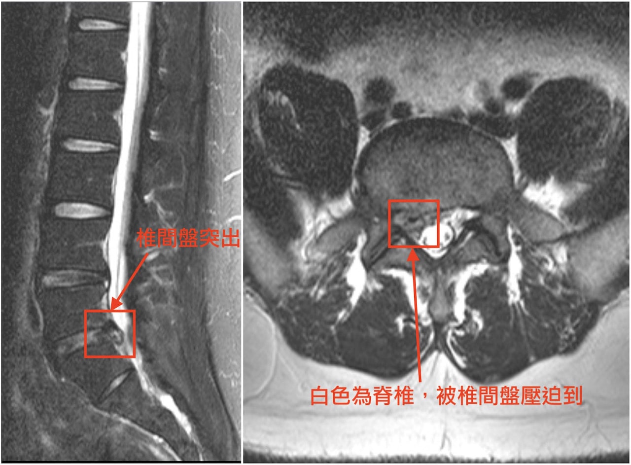 腰椎間盤突出-復建-脊椎微創手術推薦-內視鏡脊椎手術-費用-在第五腰椎與第一薦椎發現椎間盤突出往下壓迫到右邊的神經