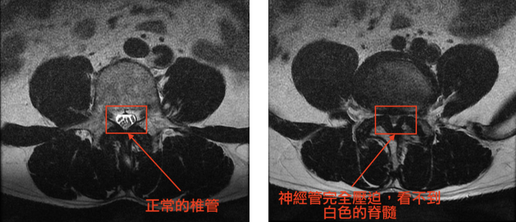 椎間管狹窄合併脊椎滑脫 用雙通道內視鏡脊椎微創手術做椎體融合術 陳奕霖醫師