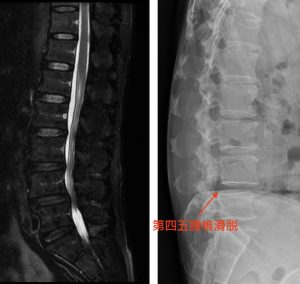微創脊椎內視鏡手術是什麼 椎間盤突出 坐骨神經痛 椎間管狹窄推薦必看
