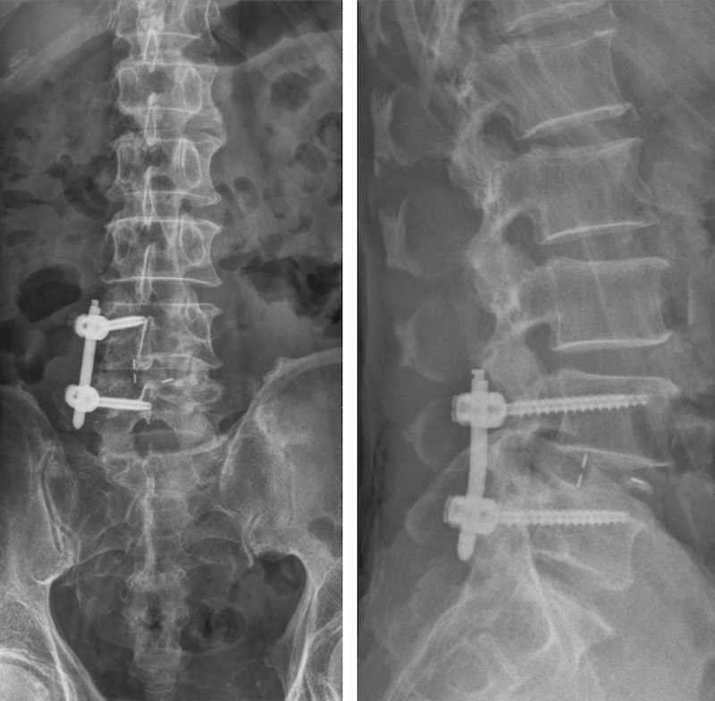 椎間管狹窄-脊椎滑脫-脊椎微創手術費用-脊椎融合術-永和耕莘醫院骨科-陳奕霖醫師-透過X光機定位打釘子固定滑脫的位置