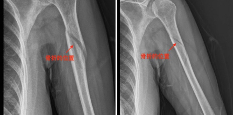 肱骨骨折-左上手臂-台北骨科-永和耕莘醫院-陳奕霖醫師