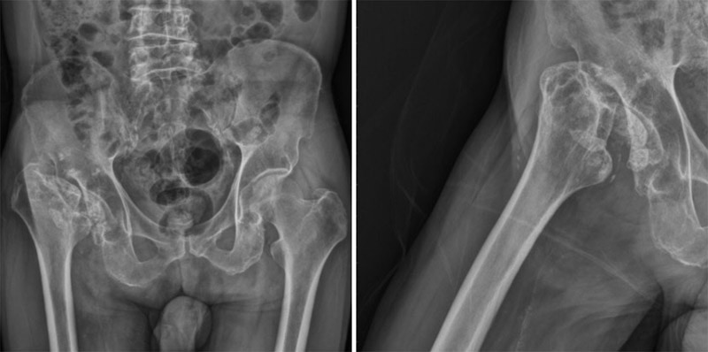 人工髖關節置換手術案例 陳奕霖醫師 永和耕莘醫院骨科醫師 永和骨科推薦