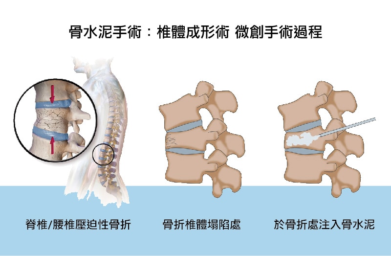 骨水泥手術-椎體成形術手術過程