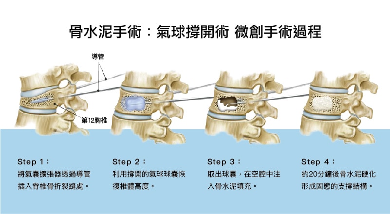 骨水泥手術-氣球撐開術-手術過程