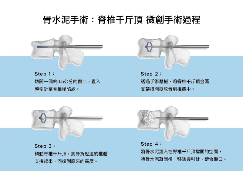 骨水泥手術-脊椎千斤頂-微創金屬支架撐開器-手術過程