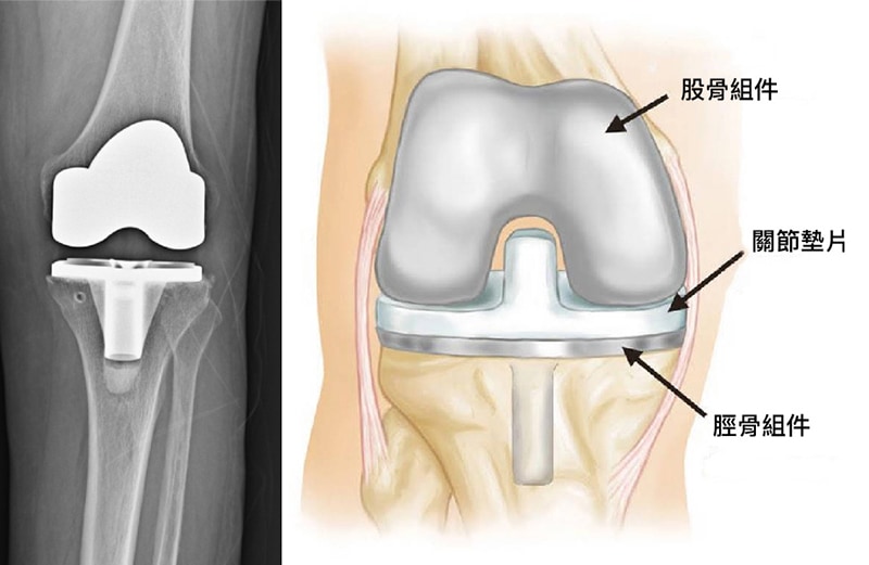 膝關節置換術-人工膝關節手術-微創手術