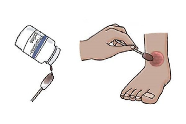 骨折術後護理-傷口換藥步驟-步驟5-使用肥皂清洗雙手-用無菌棉枝及優碘以Z字型消毒傷口-至少維持30-60秒