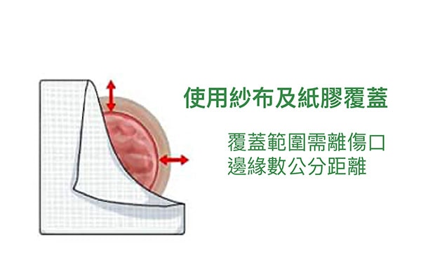 骨折術後護理-傷口換藥步驟-步驟6-使用紗布及紙膠將傷口覆蓋起來