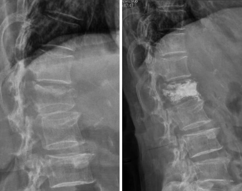 骨水泥手術 脊椎壓迫性骨折 陳奕霖醫師 永和耕莘醫院骨科醫師 永和骨科推薦