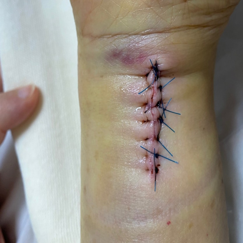 骨折術後護理 陳奕霖醫師 永和耕莘醫院骨科醫師 永和骨科推薦