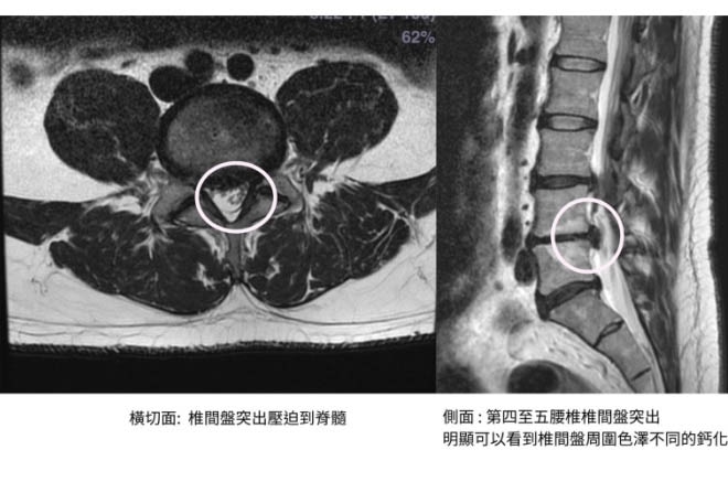 脊椎微創手術術前，核磁共振影像顯示第四至第五腰椎椎間盤突出合併鈣化