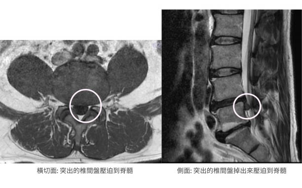 第四至第五腰椎椎間盤突出核磁共振影像，採椎間盤突出微創手術治療