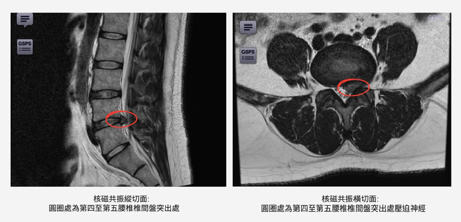 腰椎椎間盤突出的核磁共振影像，顯示第四至第五腰椎椎間盤突出壓迫神經之處
