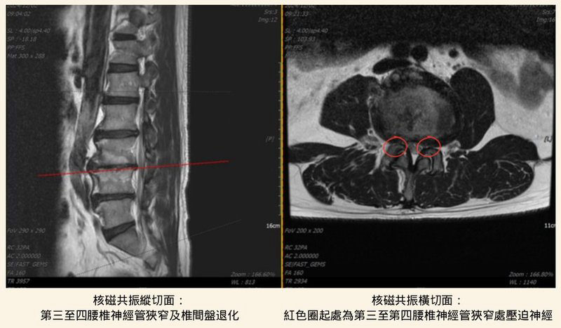 L3至L4腰椎神經管狹窄合併椎間盤退化MRI影像